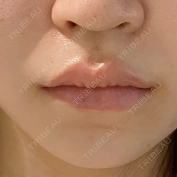 ヒアルロン酸注入（唇） 目白ホワイトクリニック DAY 1 メイン用