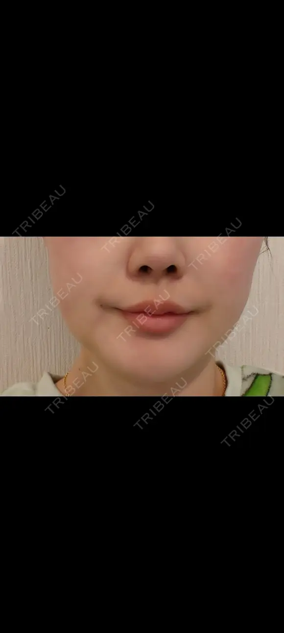 脂肪吸引（顔） THE CLINIC（ザ・クリニック） 大阪院 DAY 12 メイン用