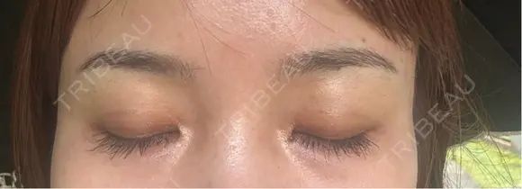 アートメイク（眉） 表参道メディカルクリニック 広島院 DAY 8 メイン用