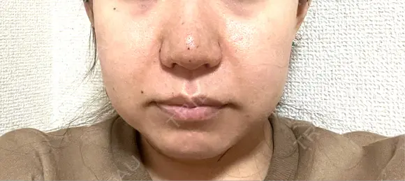 鼻尖形成（切開） / 小鼻縮小（切開） / 軟骨移植 ASTRA BEAUTY CLINIC DAY 6 メイン用