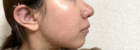 鼻尖形成（切開） / 小鼻縮小（切開） / 軟骨移植 ASTRA BEAUTY CLINIC DAY 6 メイン用