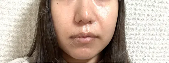 鼻尖形成（切開） / 小鼻縮小（切開） / 軟骨移植 ASTRA BEAUTY CLINIC DAY 30 メイン用