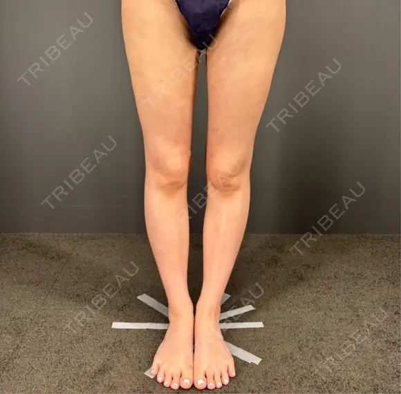 脂肪吸引（脚） / 豊胸（脂肪注入） GRACIA clinic 【グラシアクリニック】 DAY 39 メイン用