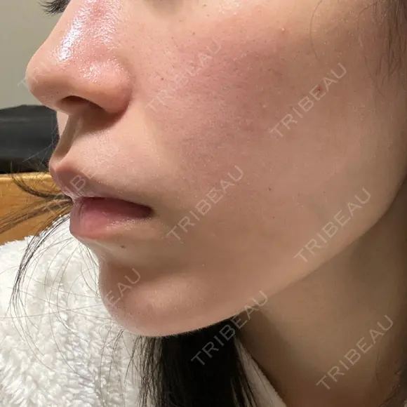 ルメッカ ルラ美容クリニック 札幌本院 DAY 4 メイン用