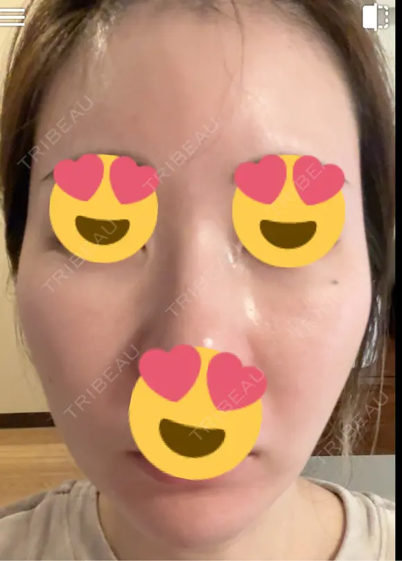 ピーリング（ハリ・ツヤ） / ピコスポット ビューティー和心クリニック 浅草院 DAY 3 メイン用