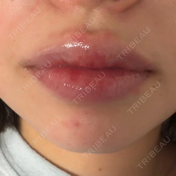 肌ヒアルロン酸注入（たるみ・シワ改善） / シワ取りボトックス / RF（高周波）たるみ治療 東京シルククリニック 東京神田院 AFTER メイン用