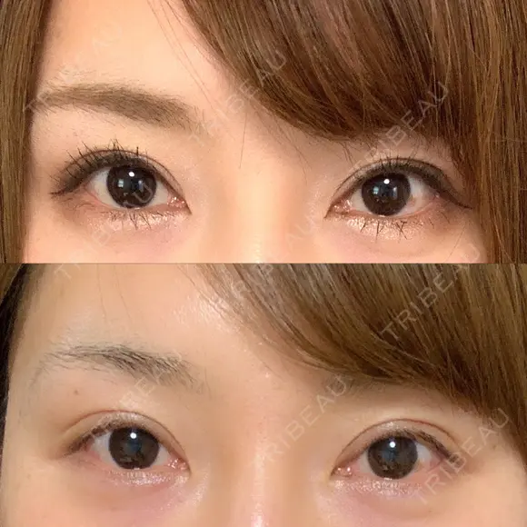 二重切開 / 眼瞼下垂（切開） / 上まぶたたるみ取り 湘南美容クリニック 新宿南口院 DAY 422 メイン用