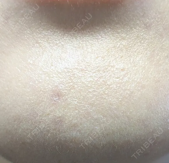 ほくろ・いぼ除去レーザー（肌） プライベートスキンクリニック 梅田本院 DAY 17 メイン用