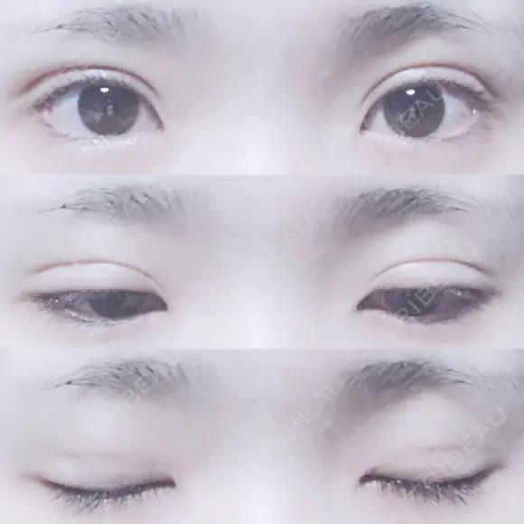 二重埋没 湘南美容クリニック 長野院 DAY 13 メイン用