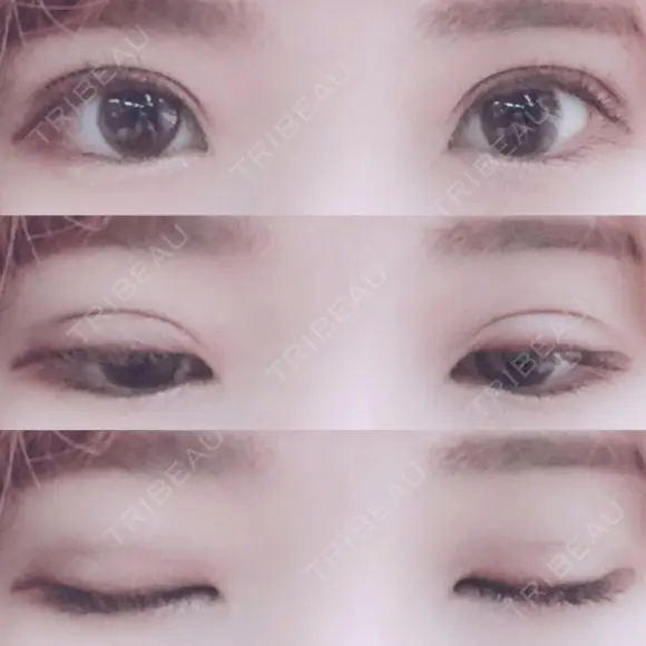 二重埋没 湘南美容クリニック 長野院 DAY 15 メイン用