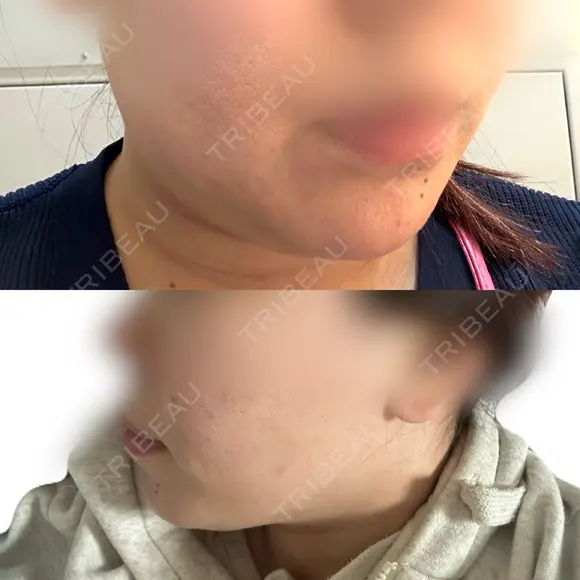 ハイフ（顔） 表参道メディカルクリニック 名古屋院 AFTER メイン用