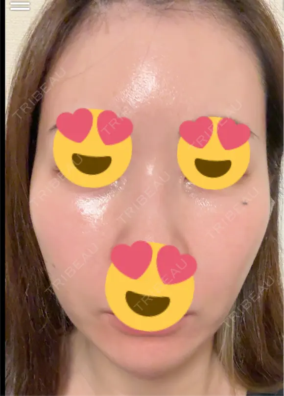 ピーリング（ハリ・ツヤ） / ピコスポット ビューティー和心クリニック 浅草院 DAY 4 メイン用