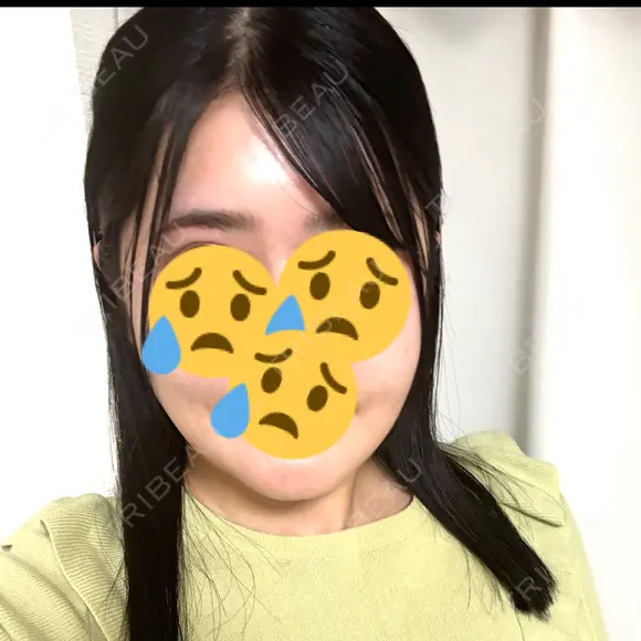 骨切り（あご） / 骨削り（エラ） / 骨削り（頬） リッツ美容外科 東京院 DAY 22 メイン用