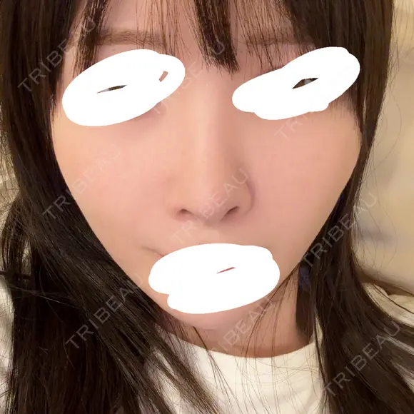 鼻中隔延長（切開） / その他（鼻） / 軟骨移植 / 鼻孔縁下降 / 鼻柱下降・鼻唇角形成（猫手術） KIHARU CLINIC DAY 15 メイン用