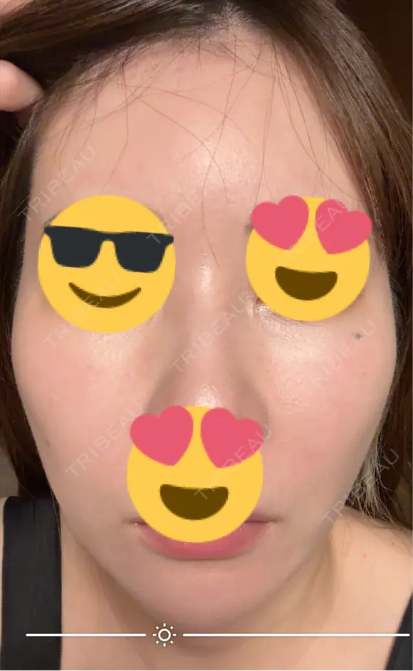 ピーリング（ハリ・ツヤ） / ピコスポット ビューティー和心クリニック 浅草院 DAY 7 メイン用