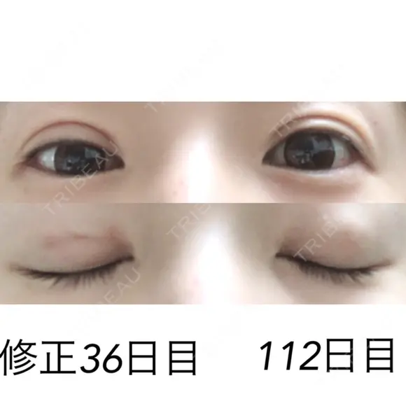 二重埋没 / 目元修正 湘南美容クリニック 広島院 DAY 36 メイン用