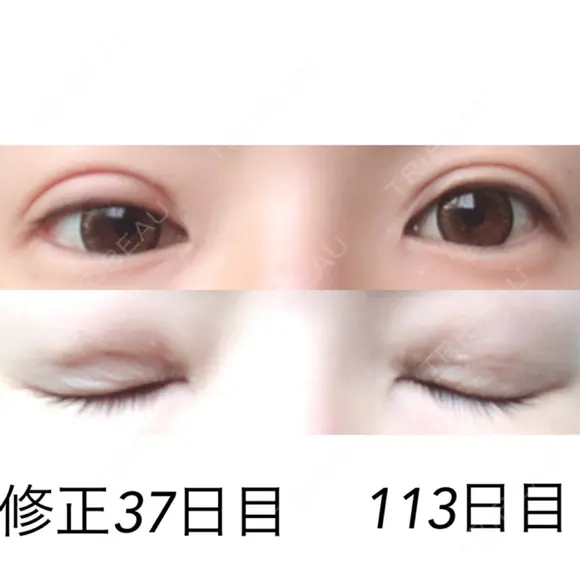 二重埋没 / 目元修正 湘南美容クリニック 広島院 DAY 37 メイン用