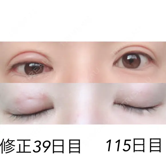 二重埋没 / 目元修正 湘南美容クリニック 広島院 AFTER メイン用