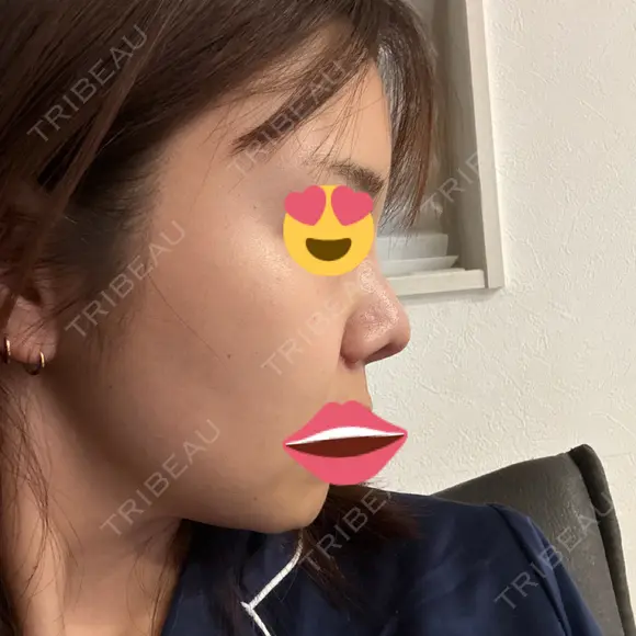 鼻尖形成（切開） / 小鼻縮小（切開） / 軟骨移植 / 眉間プロテーゼ / 鼻柱下降・鼻唇角形成（猫手術） グローバルビューティークリニック 大阪院 DAY 55 メイン用