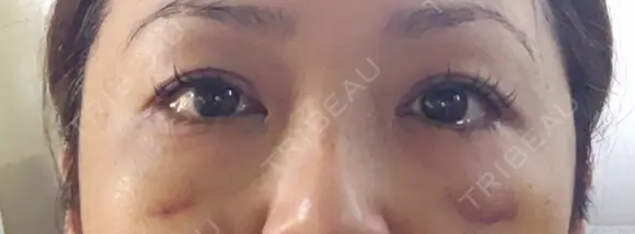 下まぶたたるみ取り 湘南美容クリニック 千葉センシティ院 DAY 8 メイン用