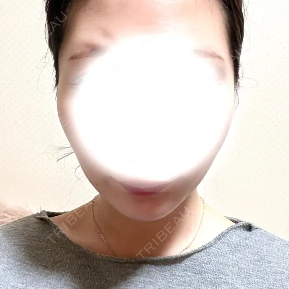 糸リフト / バッカルファット除去 / 脂肪吸引（顔） / ジョールファット除去 / ボトックス（あご） / ボトックス（エラ・小顔） アリエル美容クリニック 大宮院 DAY 131 メイン用