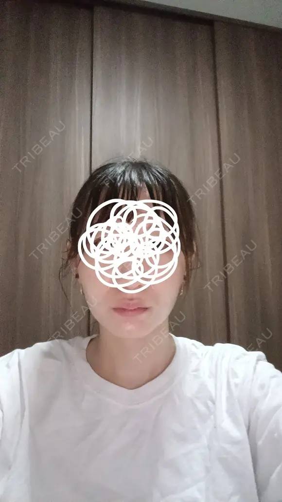 ボトックス（口角） DMTC CLINIC 日本橋院 AFTER メイン用