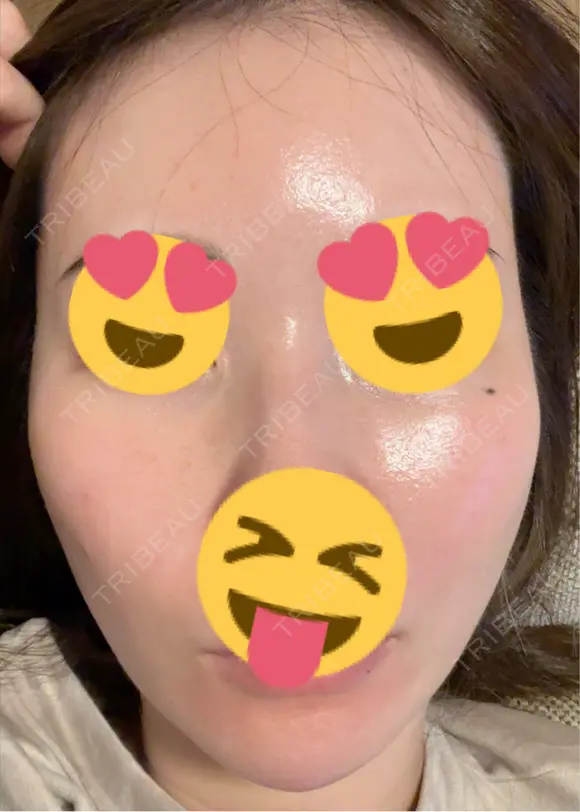 ピーリング（ハリ・ツヤ） / ピコスポット ビューティー和心クリニック 浅草院 DAY 8 メイン用