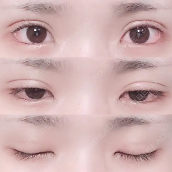 二重埋没 湘南美容クリニック 長野院 DAY 15 メイン用