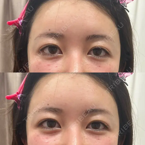 肌ヒアルロン酸注入（たるみ・シワ改善） しのぶ皮膚科 AFTER メイン用