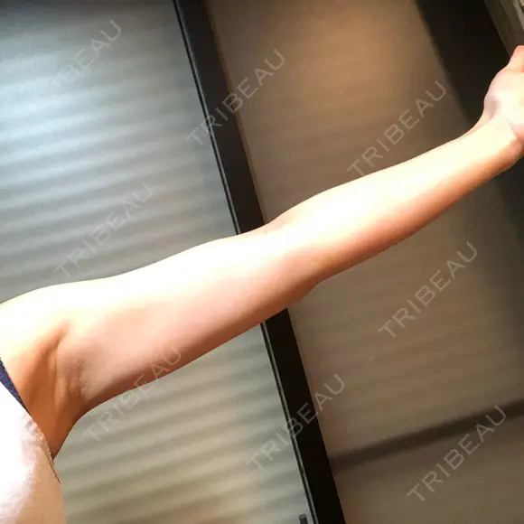 脂肪吸引（二の腕） / 脂肪溶解注射（二の腕） THE SKINNY CLINIC（ザ・スキニークリニック） DAY 13 メイン用