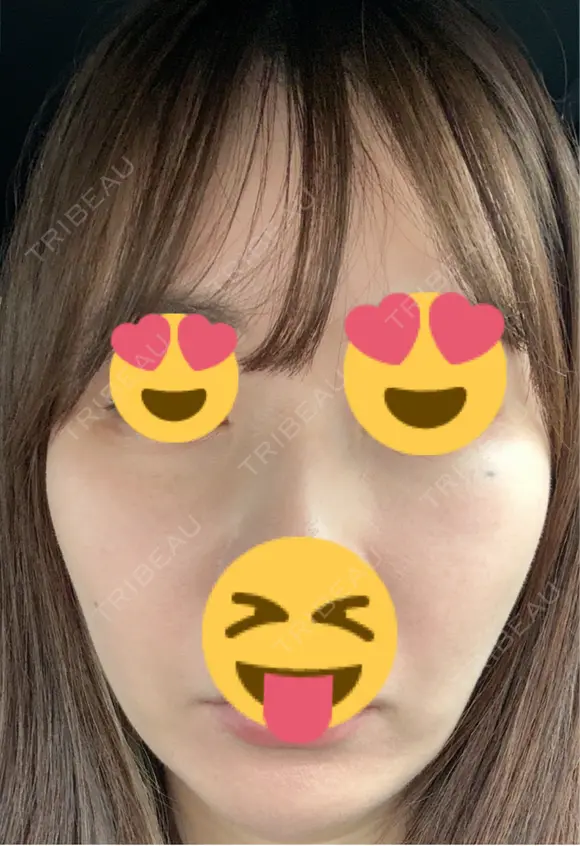 ピーリング（ハリ・ツヤ） / ピコスポット ビューティー和心クリニック 浅草院 DAY 9 メイン用