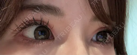 二重切開 / 眼瞼下垂（切開） / その他（目元） / 目尻切開 / タレ目形成・グラマラスライン（切開） オーキッド美容クリニック東京御徒町 AFTER メイン用