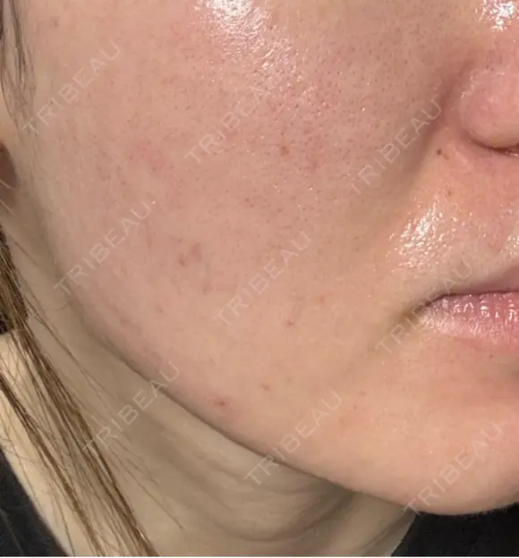 エレクトロポレーション / 毛穴洗浄（ハイドラフェイシャルなど） / ニードルRF（ポテンツァなど） クレオビューティークリニック AFTER メイン用