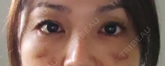 下まぶたたるみ取り 湘南美容クリニック 千葉センシティ院 DAY 10 メイン用
