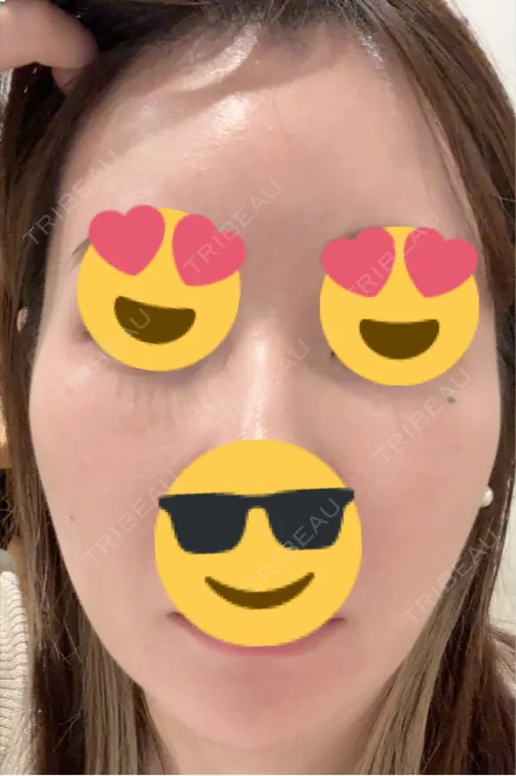 ピーリング（ハリ・ツヤ） / ピコスポット ビューティー和心クリニック 浅草院 AFTER メイン用