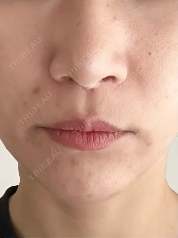 人中短縮 / 小鼻縮小（非切開） 湘南美容クリニック 仙台院 DAY 113 メイン用