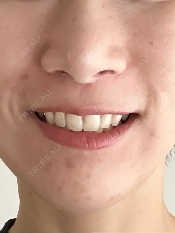 人中短縮 / 小鼻縮小（非切開） 湘南美容クリニック 仙台院 DAY 113 メイン用