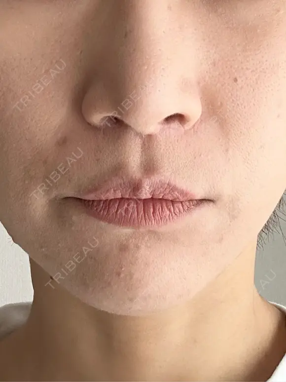 人中短縮 / 小鼻縮小（非切開） 湘南美容クリニック 仙台院 AFTER メイン用