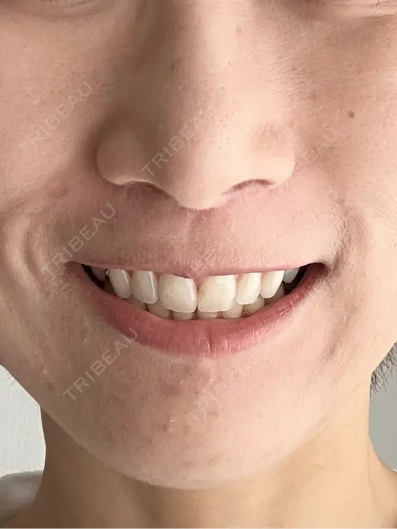 人中短縮 / 小鼻縮小（非切開） 湘南美容クリニック 仙台院 DAY 128 メイン用