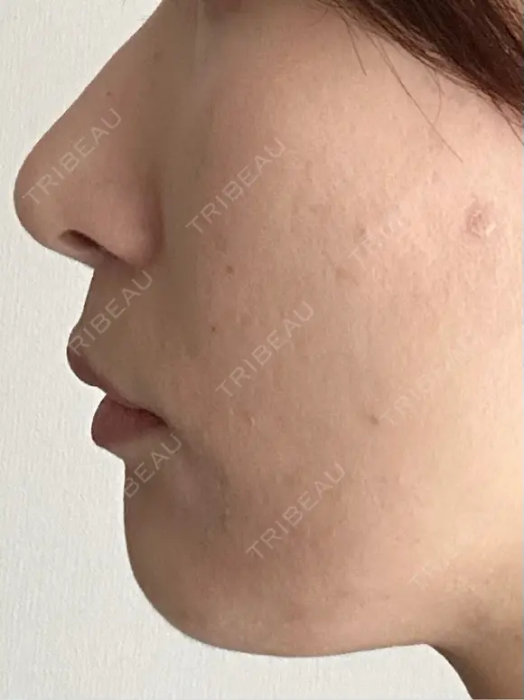 人中短縮 / 小鼻縮小（非切開） 湘南美容クリニック 仙台院 DAY 128 メイン用