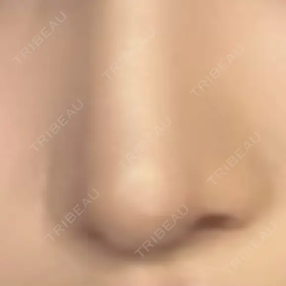 鼻尖形成（切開） / 小鼻縮小（切開） / 軟骨移植 / 鼻柱下降・鼻唇角形成（猫手術） / ボトックス（エラ・小顔） ASTRA BEAUTY CLINIC DAY 69 メイン用