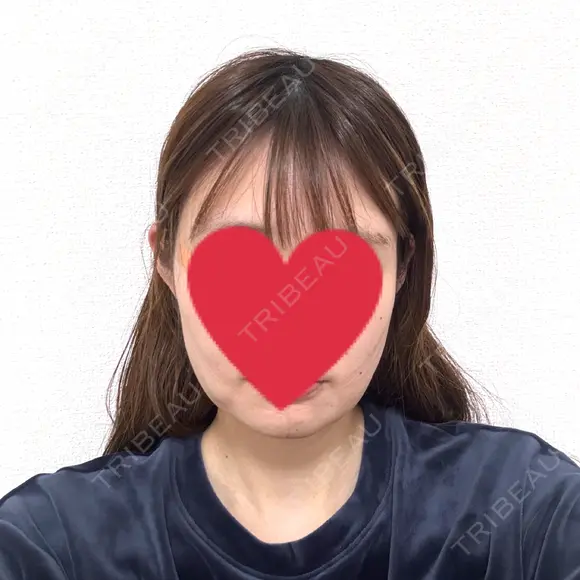 糸リフト / 脂肪吸引（顔） / ボトックス（エラ・小顔） Wing clinic 豊中駅前院 DAY 0 メイン用