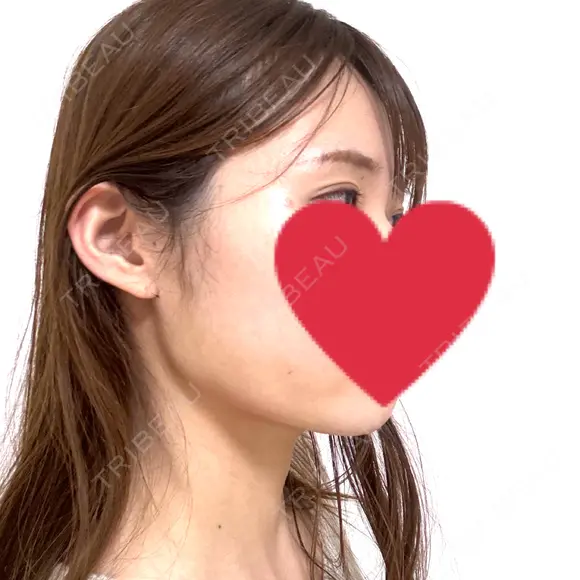 糸リフト / 脂肪吸引（顔） / ボトックス（エラ・小顔） Wing clinic 豊中駅前院 DAY 1 メイン用