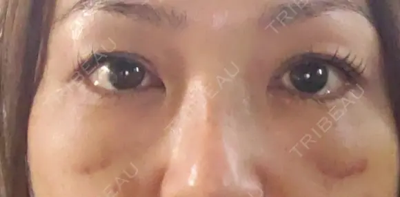 下まぶたたるみ取り 湘南美容クリニック 千葉センシティ院 DAY 11 メイン用