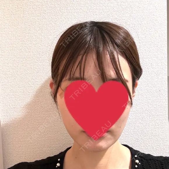 糸リフト / 脂肪吸引（顔） / ボトックス（エラ・小顔） Wing clinic 豊中駅前院 DAY 2 メイン用