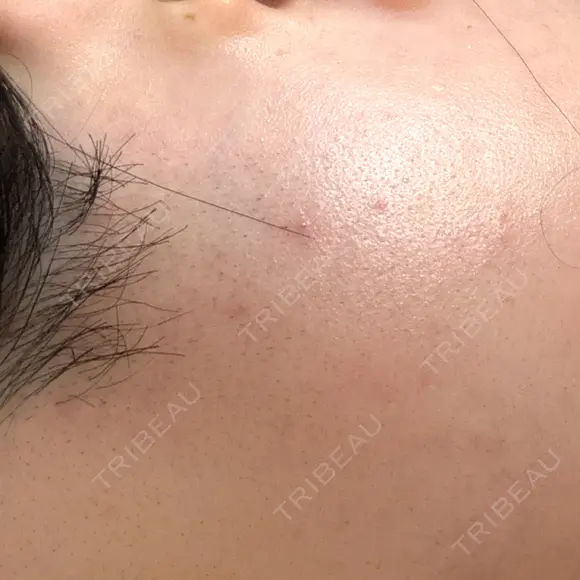 医療脱毛（顔） エスクリニック 恵比寿 AFTER メイン用