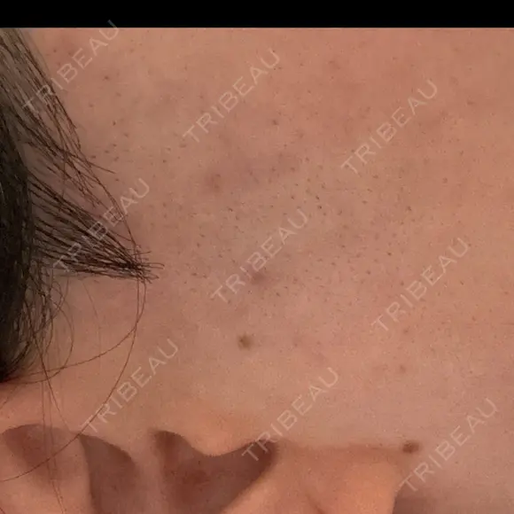 医療脱毛（顔） エスクリニック 恵比寿 DAY 31 メイン用