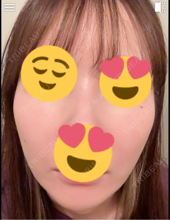 ピーリング（ハリ・ツヤ） / ピコスポット ビューティー和心クリニック 浅草院 DAY 5 メイン用