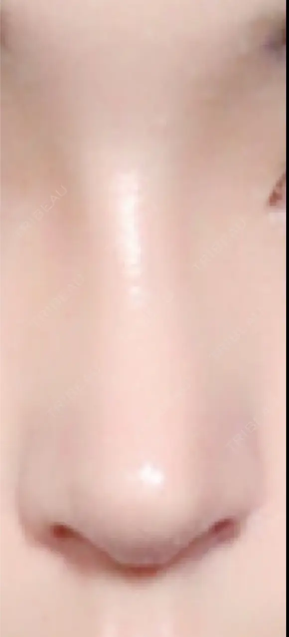 隆鼻術 / 鼻尖形成（切開） / 鼻中隔延長（切開） / 鼻尖縮小 FROM B整形外科 (旧バウム整形外科) DAY 18 メイン用