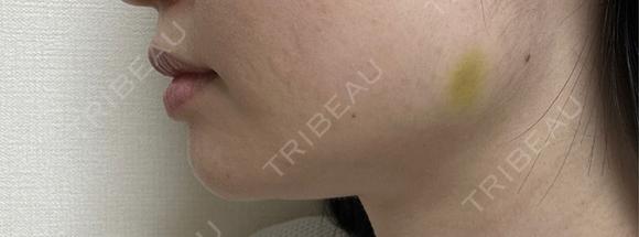 ボトックス（エラ・小顔） TCB東京中央美容外科 自由が丘院 DAY 4 メイン用